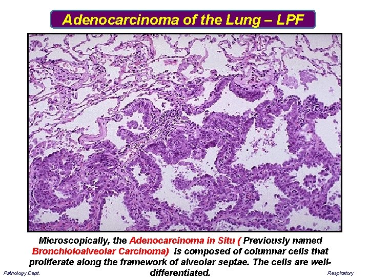 Adenocarcinoma of the Lung – LPF Microscopically, the Adenocarcinoma in Situ ( Previously named