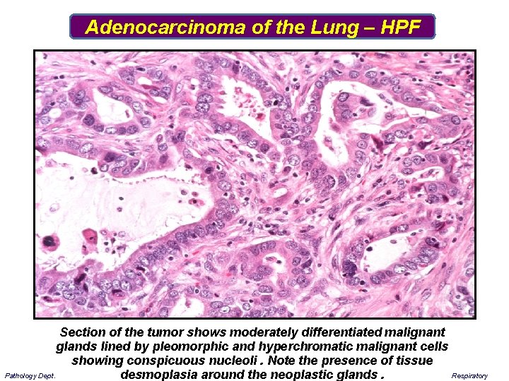 Adenocarcinoma of the Lung – HPF Section of the tumor shows moderately differentiated malignant