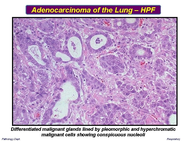 Adenocarcinoma of the Lung – HPF Differentiated malignant glands lined by pleomorphic and hyperchromatic