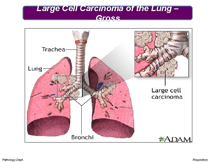 Large Cell Carcinoma of the Lung – Gross Pathology Dept. Respiratory 