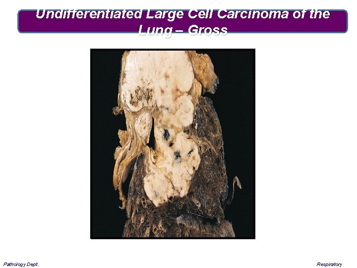 Undifferentiated Large Cell Carcinoma of the Lung – Gross Pathology Dept. Respiratory 