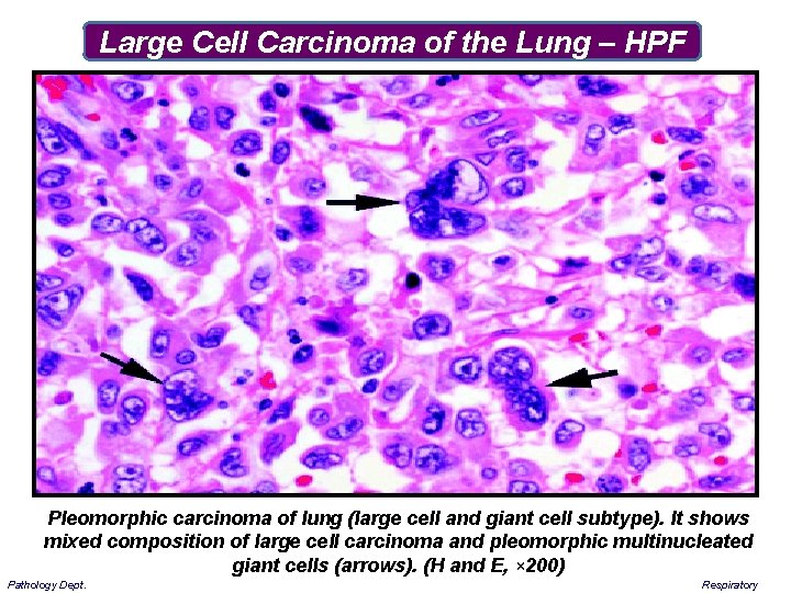 Large Cell Carcinoma of the Lung – HPF Pleomorphic carcinoma of lung (large cell