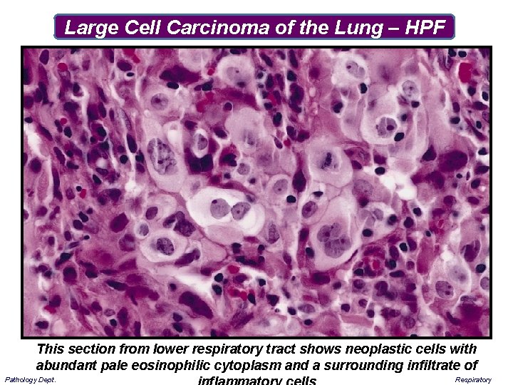 Large Cell Carcinoma of the Lung – HPF This section from lower respiratory tract