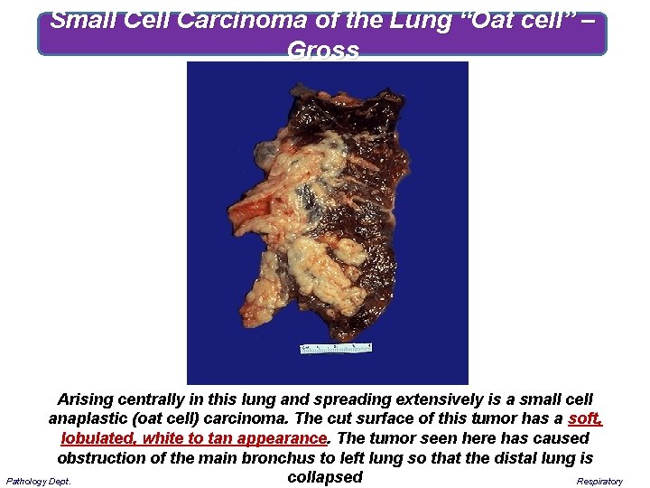 Small Cell Carcinoma of the Lung “Oat cell” – Gross Arising centrally in this