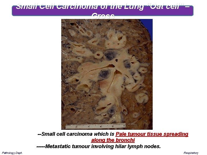 Small Cell Carcinoma of the Lung “Oat cell” – Gross --Small cell carcinoma which