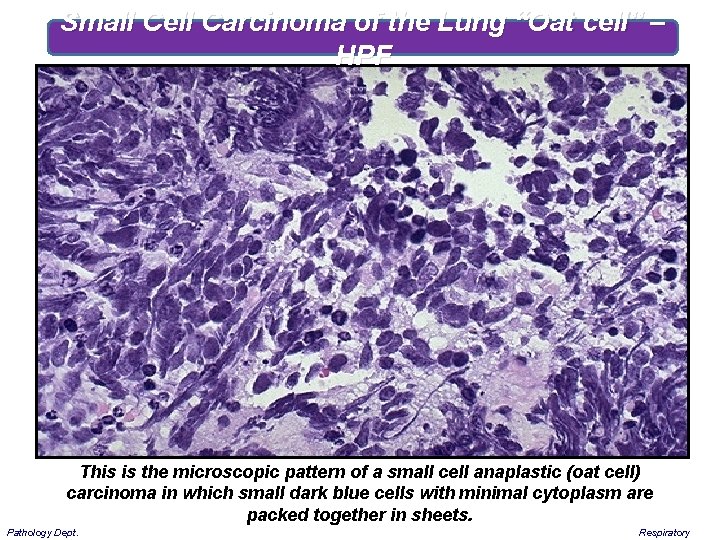 Small Cell Carcinoma of the Lung “Oat cell” – HPF This is the microscopic