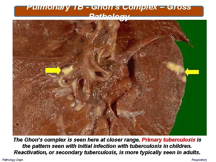 Pulmonary TB - Ghon’s Complex – Gross Pathology The Ghon’s complex is seen here