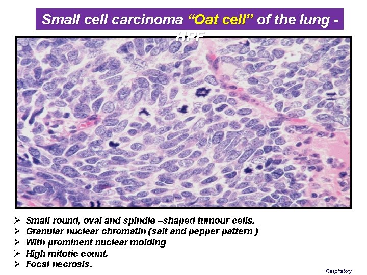 Small cell carcinoma “Oat cell” of the lung HPF Ø Ø Ø Small round,