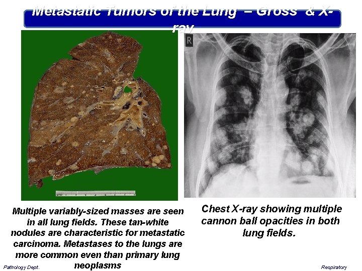 Metastatic Tumors of the Lung – Gross & Xray Multiple variably-sized masses are seen