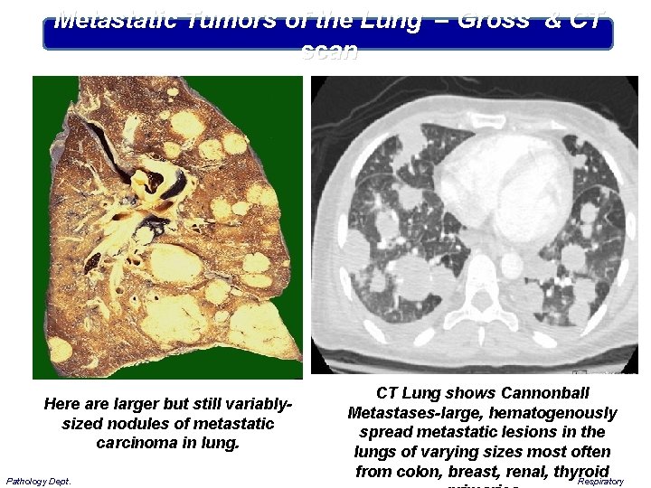 Metastatic Tumors of the Lung – Gross & CT scan Here are larger but