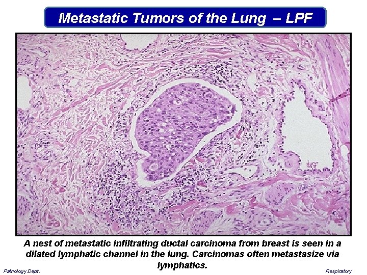 Metastatic Tumors of the Lung – LPF A nest of metastatic infiltrating ductal carcinoma