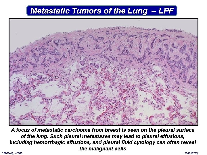 Metastatic Tumors of the Lung – LPF A focus of metastatic carcinoma from breast