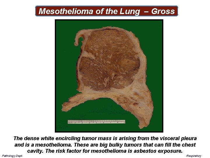 Mesothelioma of the Lung – Gross The dense white encircling tumor mass is arising