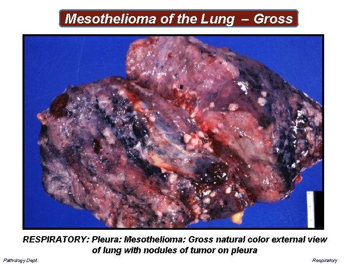 Mesothelioma of the Lung – Gross RESPIRATORY: Pleura: Mesothelioma: Gross natural color external view