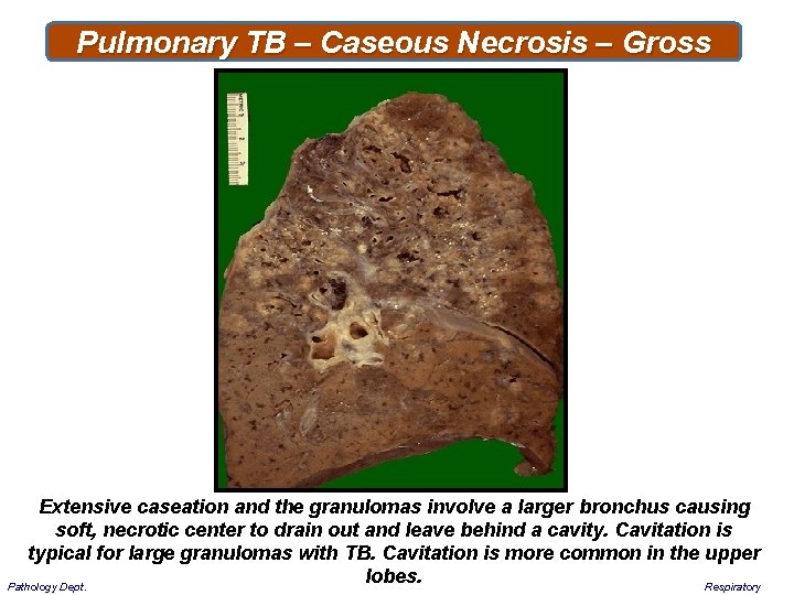 Pulmonary TB – Caseous Necrosis – Gross Extensive caseation and the granulomas involve a