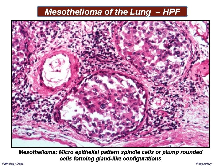 Mesothelioma of the Lung – HPF Mesothelioma: Micro epithelial pattern spindle cells or plump