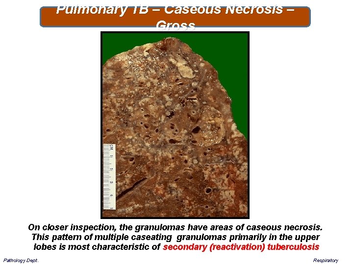 Pulmonary TB – Caseous Necrosis – Gross On closer inspection, the granulomas have areas