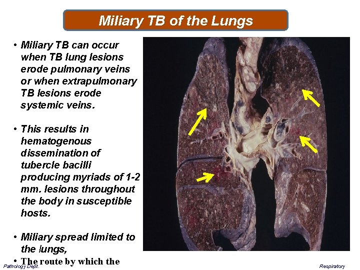 Miliary TB of the Lungs • Miliary TB can occur when TB lung lesions