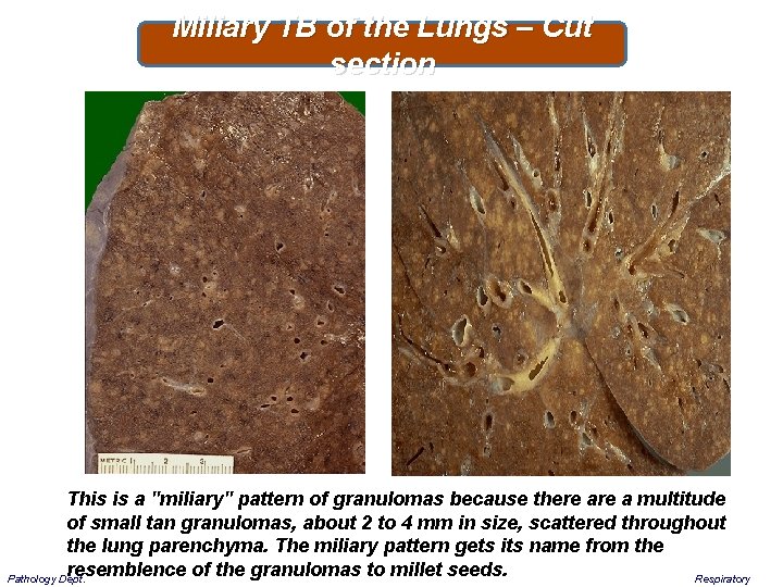 Miliary TB of the Lungs – Cut section This is a "miliary" pattern of