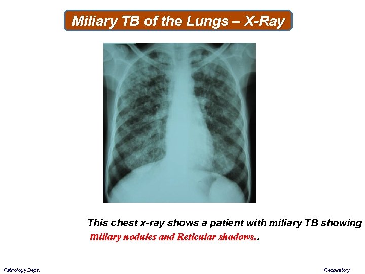 Miliary TB of the Lungs – X-Ray This chest x-ray shows a patient with