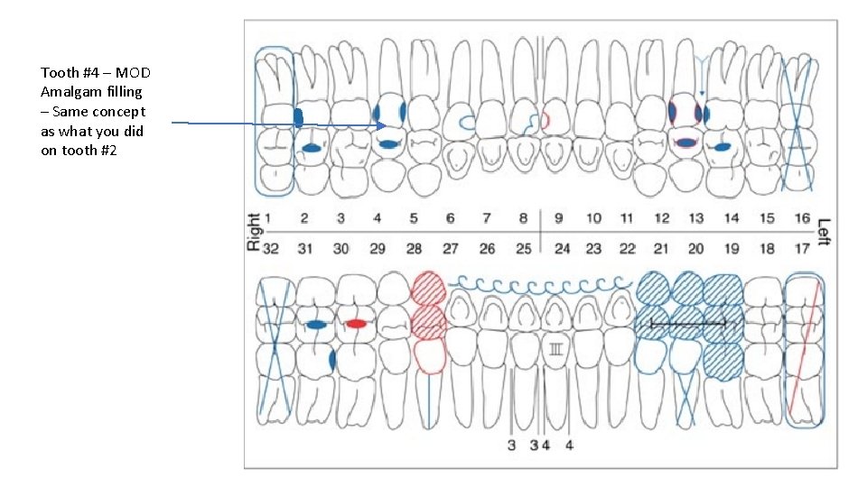 Tooth #4 – MOD Amalgam filling – Same concept as what you did on
