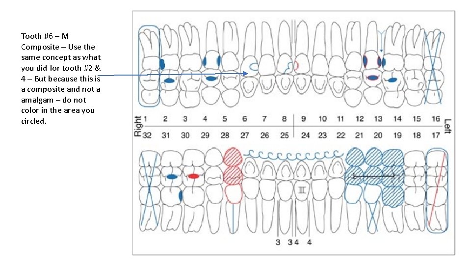 Tooth #6 – M Composite – Use the same concept as what you did