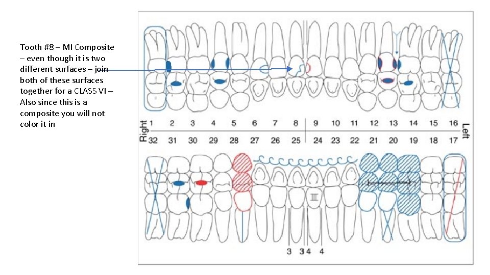 Tooth #8 – MI Composite – even though it is two different surfaces –