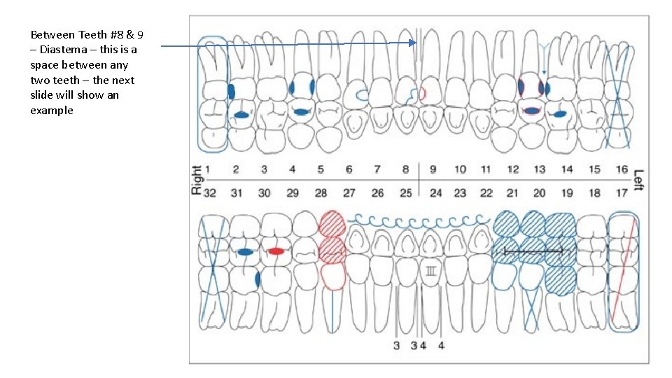 Between Teeth #8 & 9 – Diastema – this is a space between any