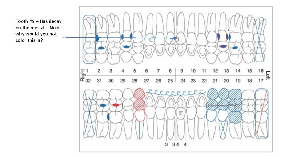 Tooth #9 – Has decay on the mesial – Now, why would you not