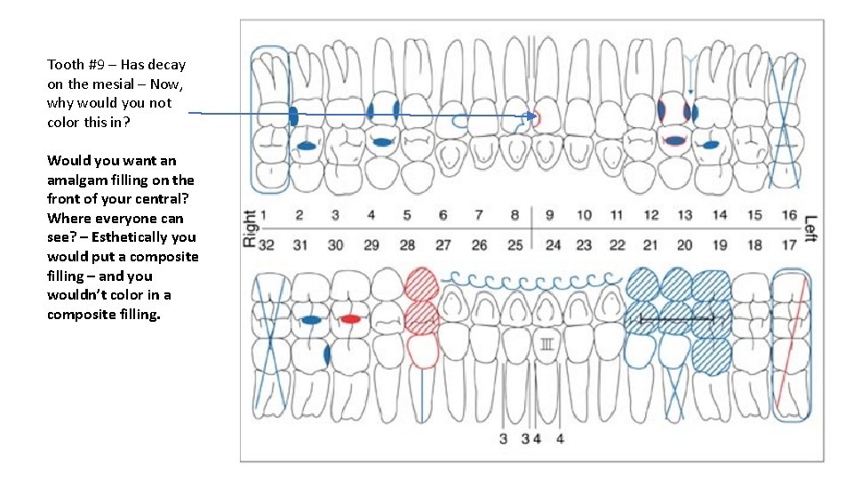 Tooth #9 – Has decay on the mesial – Now, why would you not