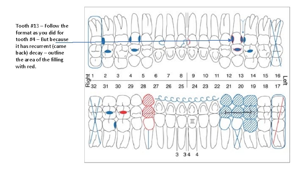 Tooth #13 – Follow the format as you did for tooth #4 – But