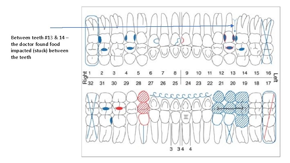 Between teeth #13 & 14 – the doctor found food impacted (stuck) between the
