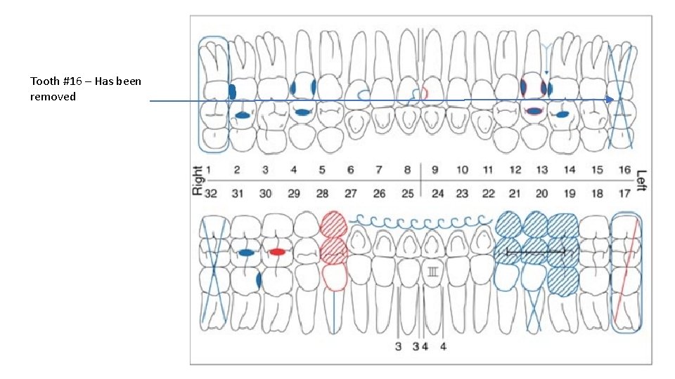 Tooth #16 – Has been removed 