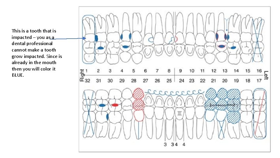 This is a tooth that is impacted – you as a dental professional cannot