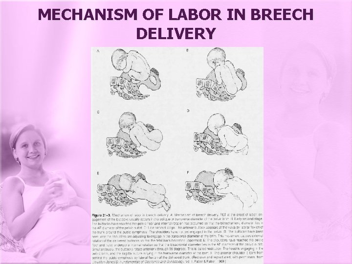 MECHANISM OF LABOR IN BREECH DELIVERY 