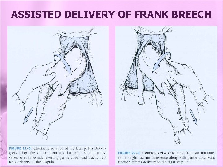 ASSISTED DELIVERY OF FRANK BREECH 
