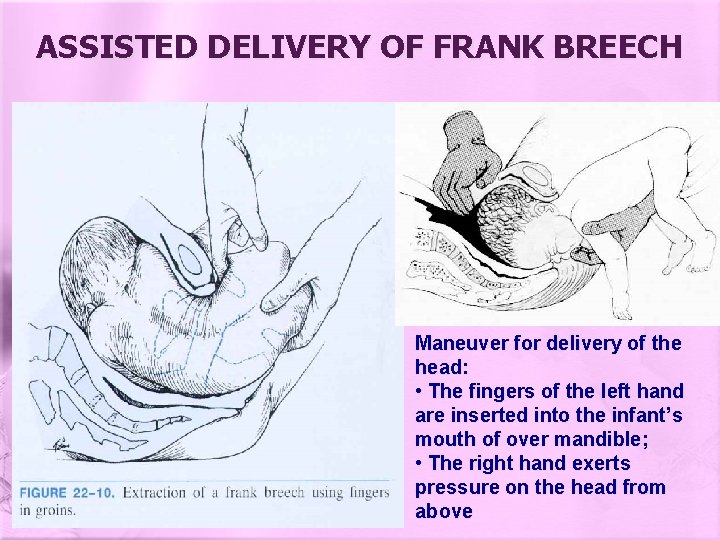 ASSISTED DELIVERY OF FRANK BREECH Maneuver for delivery of the head: • The fingers