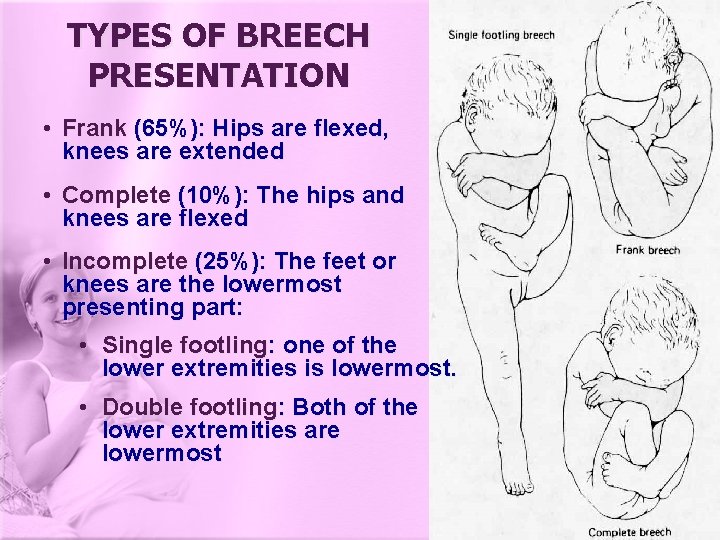 TYPES OF BREECH PRESENTATION • Frank (65%): Hips are flexed, knees are extended •