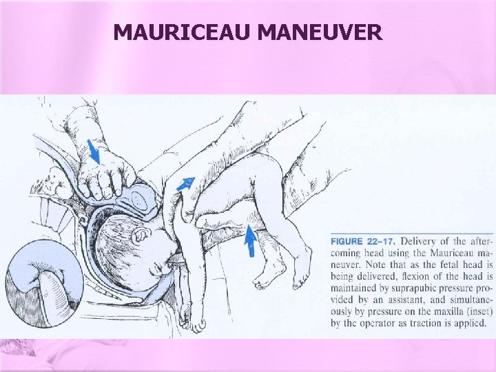 MAURICEAU MANEUVER 