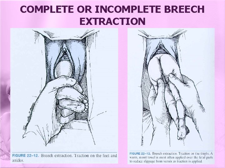 COMPLETE OR INCOMPLETE BREECH EXTRACTION 