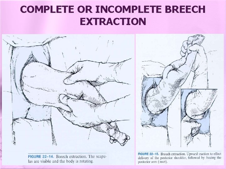 COMPLETE OR INCOMPLETE BREECH EXTRACTION 