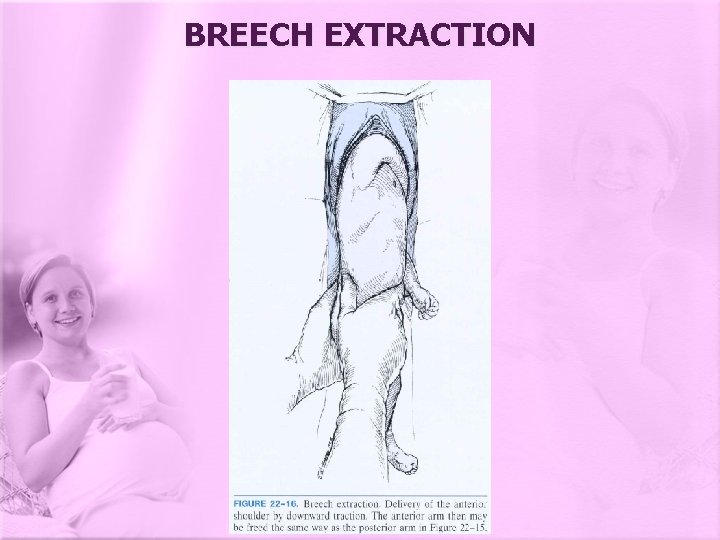 BREECH EXTRACTION 