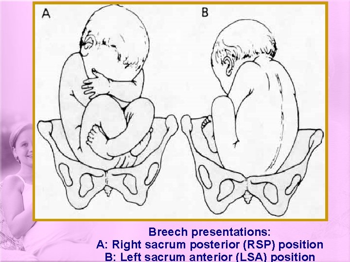 Breech presentations: A: Right sacrum posterior (RSP) position B: Left sacrum anterior (LSA) position