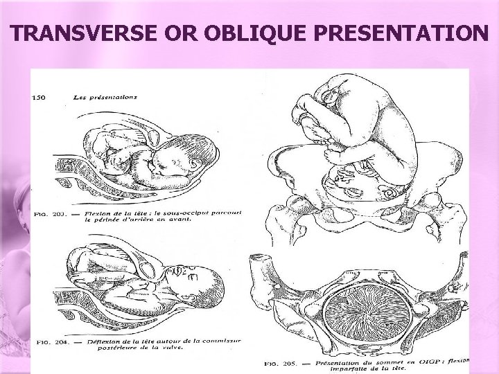 TRANSVERSE OR OBLIQUE PRESENTATION 