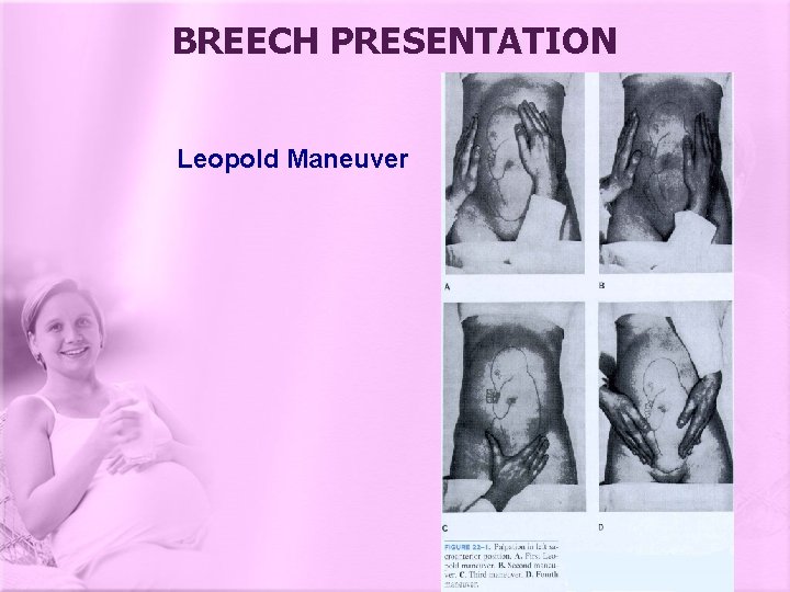 BREECH PRESENTATION Leopold Maneuver 