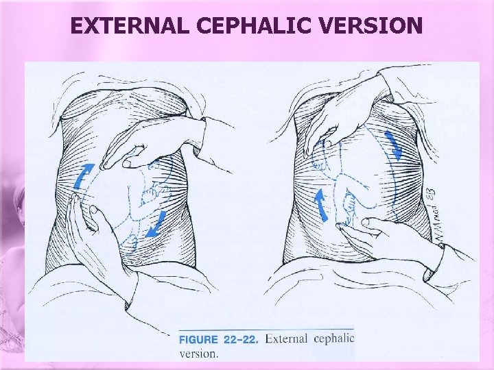 EXTERNAL CEPHALIC VERSION 