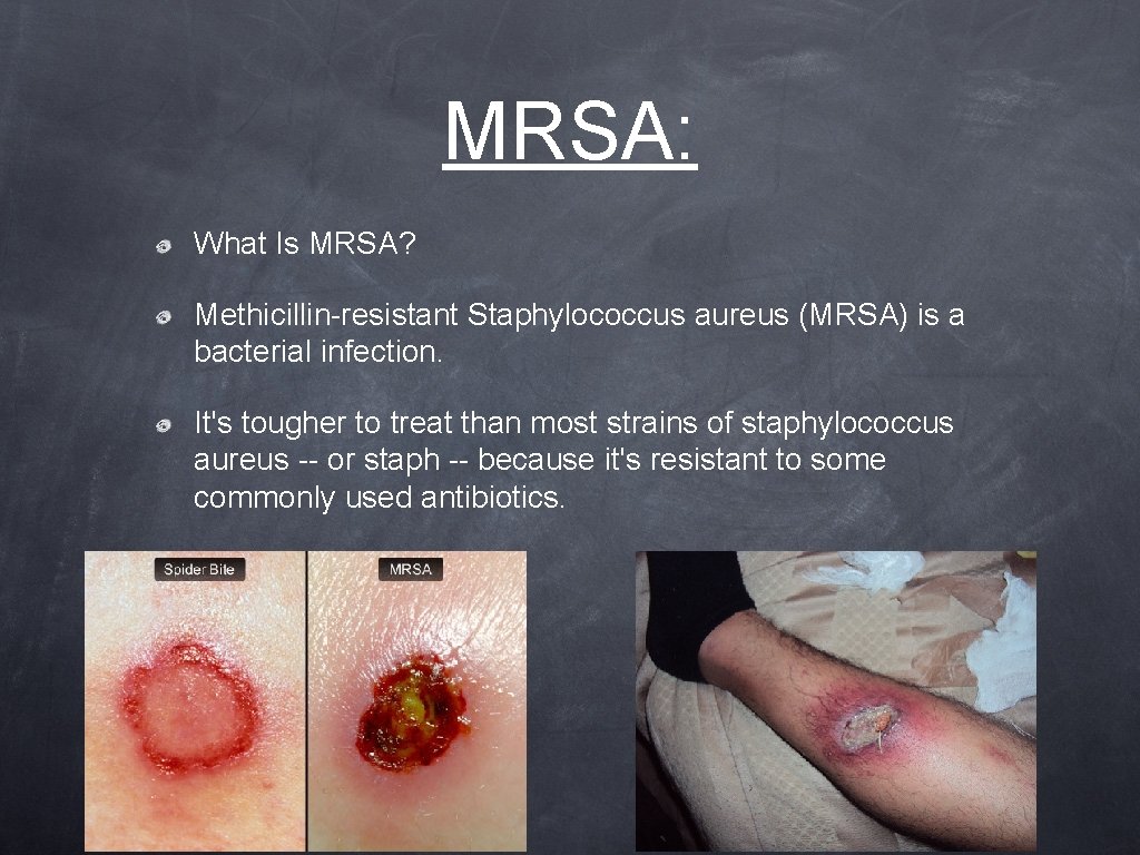 MRSA: What Is MRSA? Methicillin-resistant Staphylococcus aureus (MRSA) is a bacterial infection. It's tougher