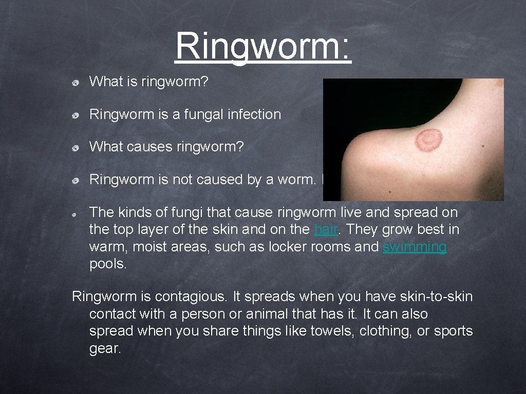 Ringworm: What is ringworm? Ringworm is a fungal infection What causes ringworm? Ringworm is