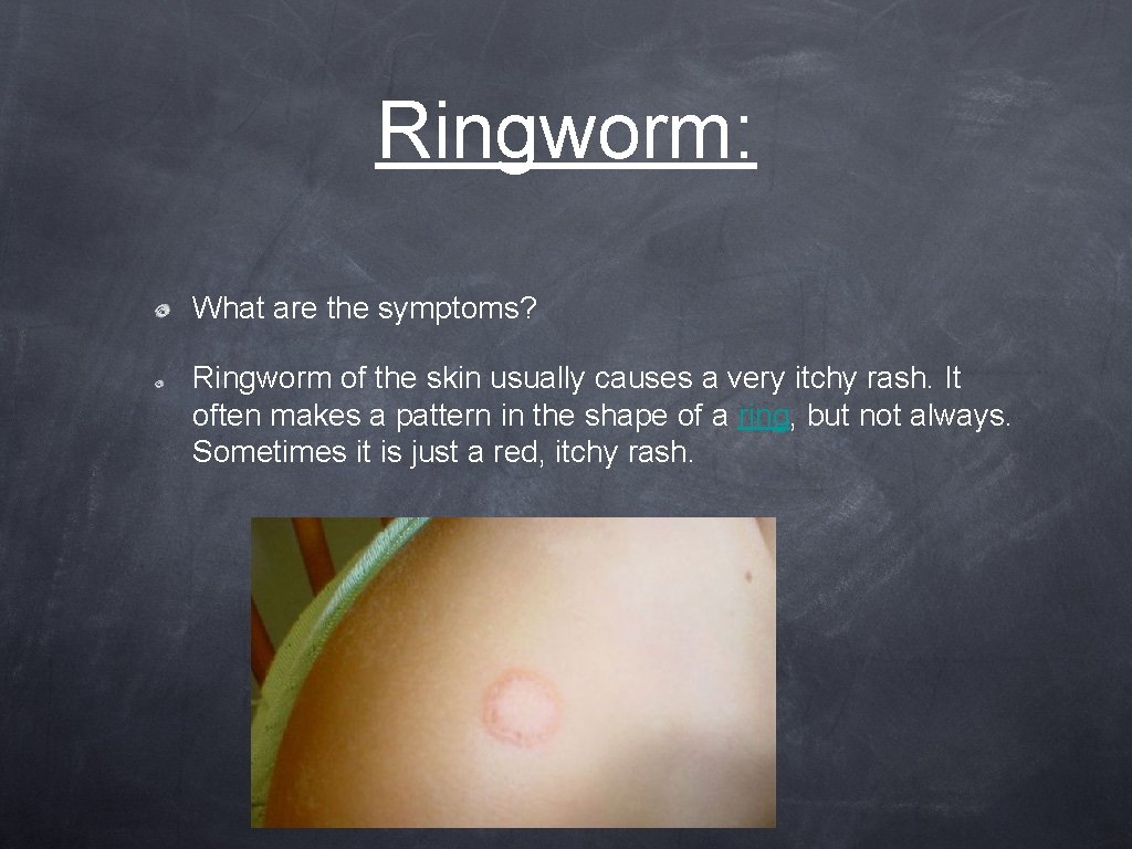 Ringworm: What are the symptoms? Ringworm of the skin usually causes a very itchy