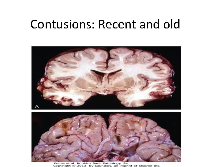 Contusions: Recent and old 
